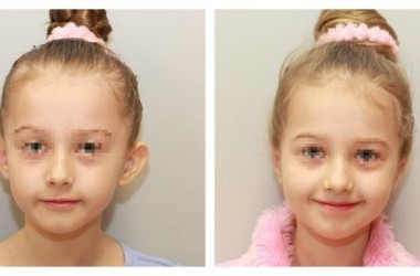 Atlėpusių ausų operacija vaikams